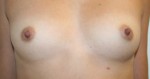 Breast Augmentation