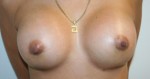 Breast Augmentation