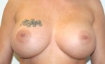 Breast Augmentation