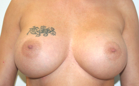Breast Augmentation
