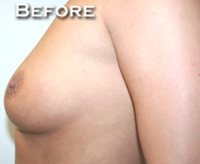 Breast Augmentation