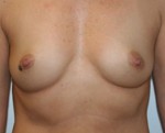 Breast Augmentation