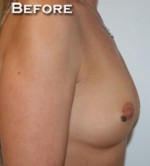 Breast Augmentation