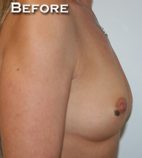 Breast Augmentation