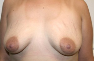 Breast Augmentation