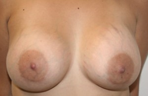 Breast Augmentation