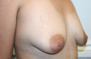 Breast Augmentation