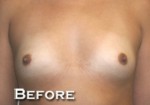 Breast Augmentation