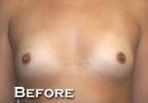 Breast Augmentation