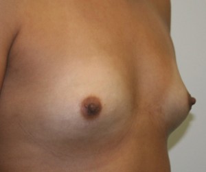 Breast Augmentation