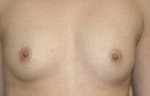 Breast Augmentation
