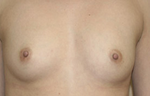 Breast Augmentation