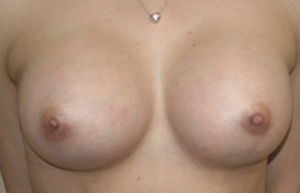 Breast Augmentation