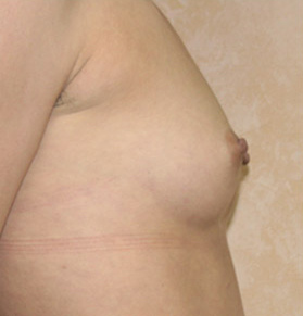 Breast Augmentation