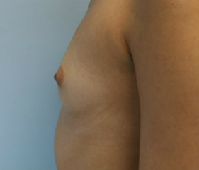 Breast Augmentation