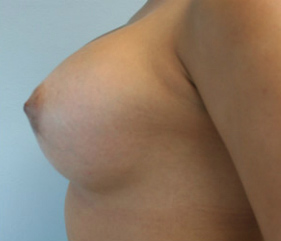 Breast Augmentation