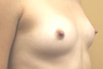 Breast Augmentation