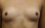 Breast Augmentation
