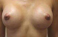 Breast Augmentation