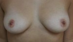 Breast Augmentation