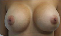 Breast Augmentation