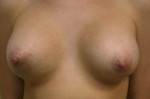 Breast Augmentation