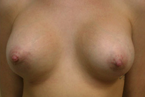 Breast Augmentation