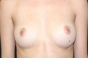 Breast Augmentation