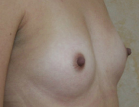 Breast Augmentation