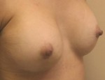 Breast Augmentation