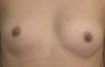 Breast Augmentation