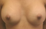 Breast Augmentation