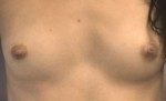 Breast Augmentation