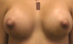 Breast Augmentation