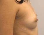 Breast Augmentation
