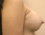 Breast Augmentation