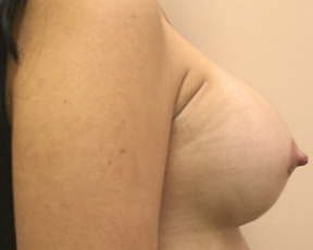 Breast Augmentation