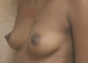 Breast Augmentation