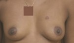 Breast Augmentation