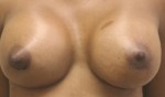 Breast Augmentation