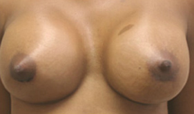 Breast Augmentation