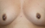 Breast Augmentation