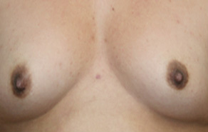 Breast Augmentation