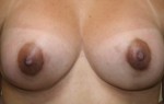 Breast Augmentation