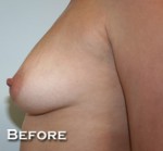 Breast Augmentation
