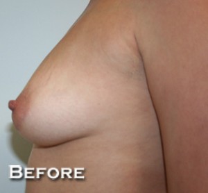 Breast Augmentation