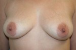 Breast Augmentation