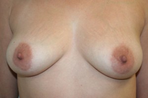 Breast Augmentation