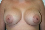 Breast Augmentation