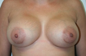 Breast Augmentation